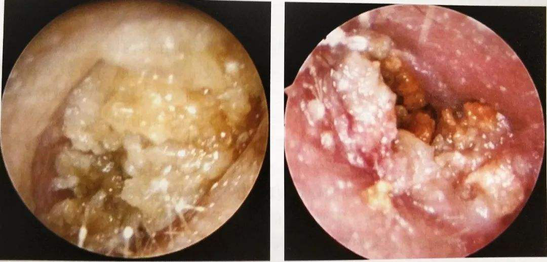 急慢性外耳道炎